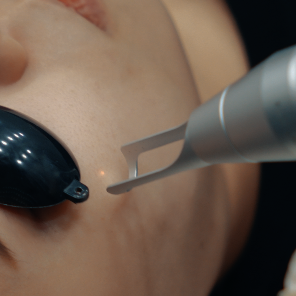Patient undergoing Pico Laser Singapore