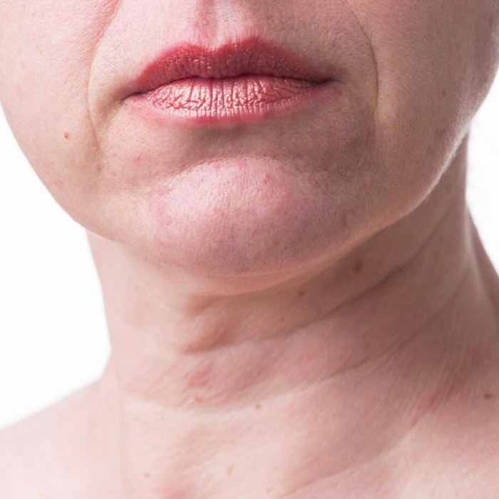neck line hifu treatment