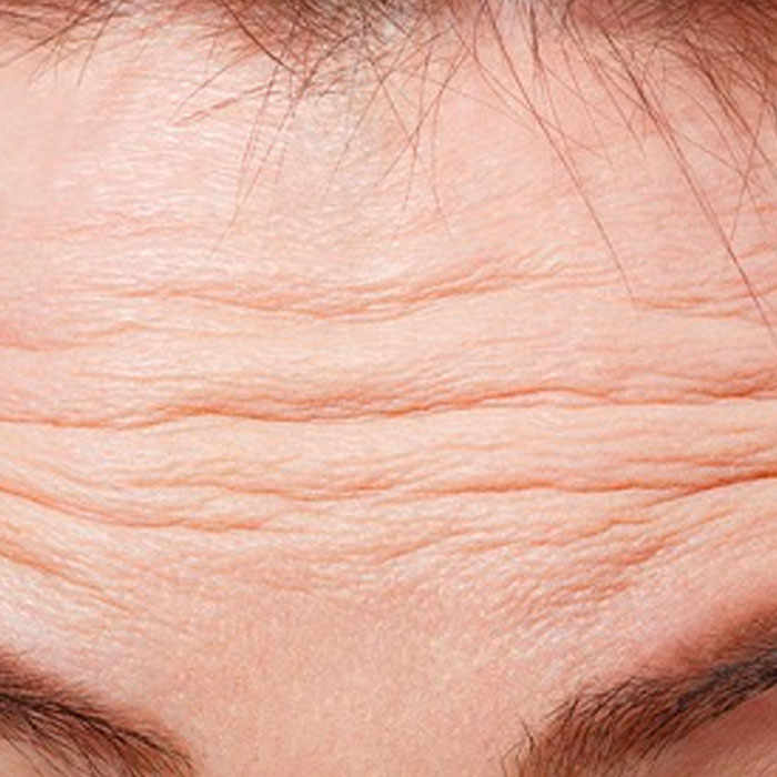 forehead line hifu treatment