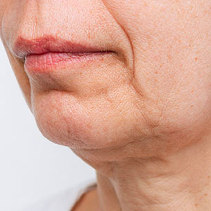 jowls hifu treatment