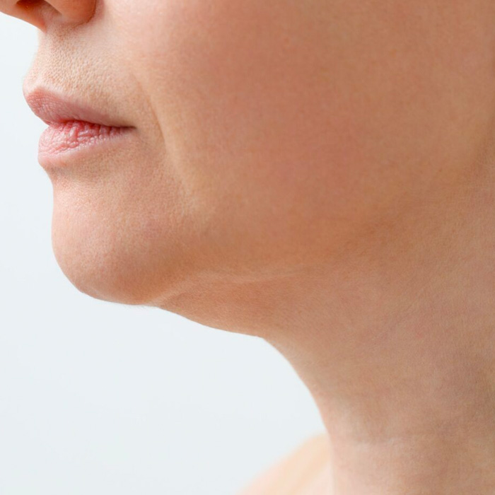 double chin hifu treatment