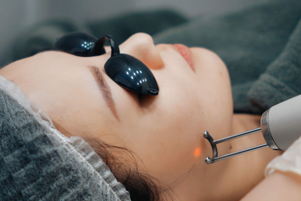 Patient undergoing Pico Laser Treatment in Singapore