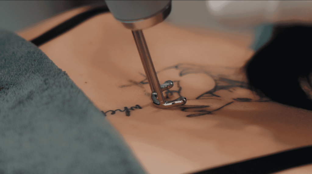 Pico Laser on Tattoo removal