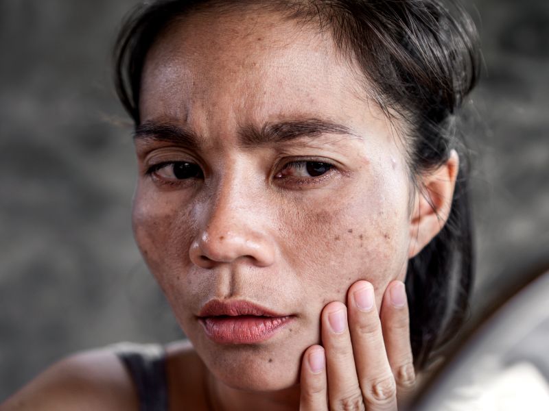 Skin Condition Pico Laser Treat