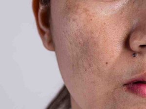 Melasma and Skin Pigmentation