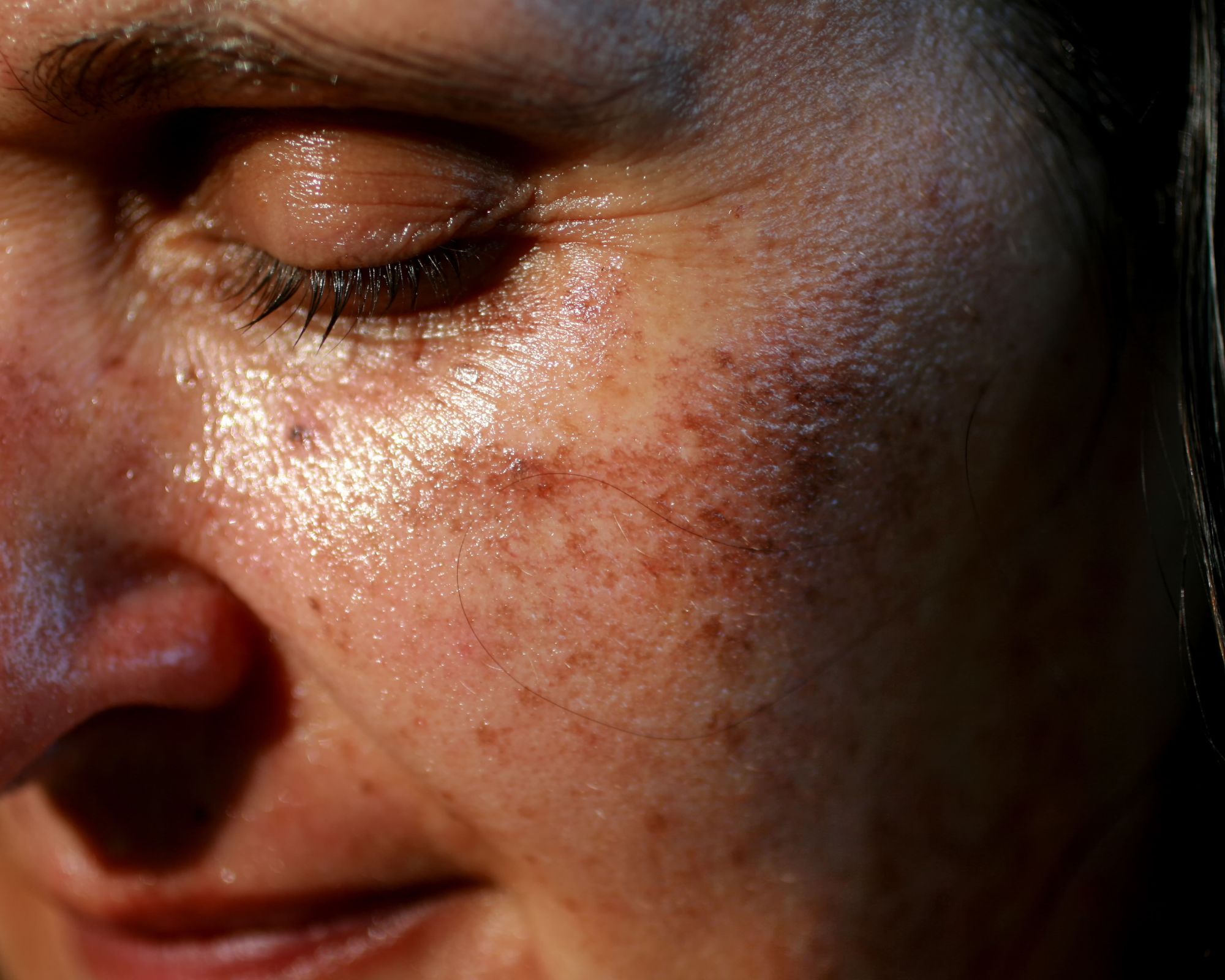 Best-Time-To-Do-Pico-Laser-Treatment
